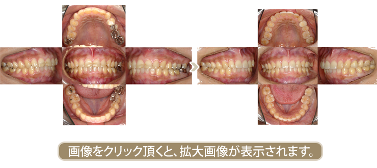 審美歯科治療&インプラント治療症例