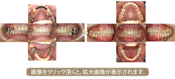 審美歯科治療&インプラント治療症例