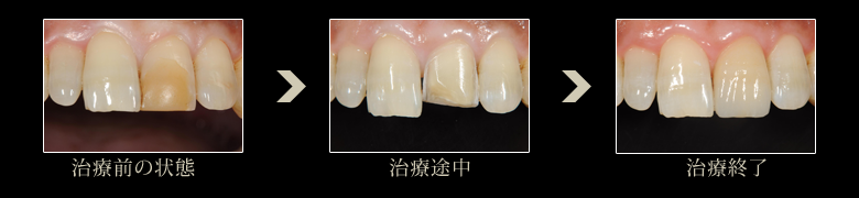 審美歯科症例:ラミネートベニア2