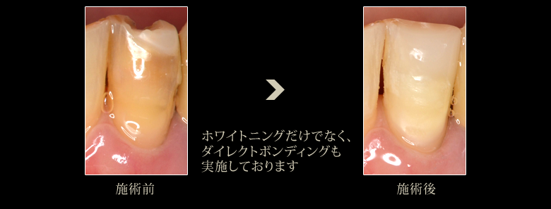 審美歯科症例:ホワイトニング3