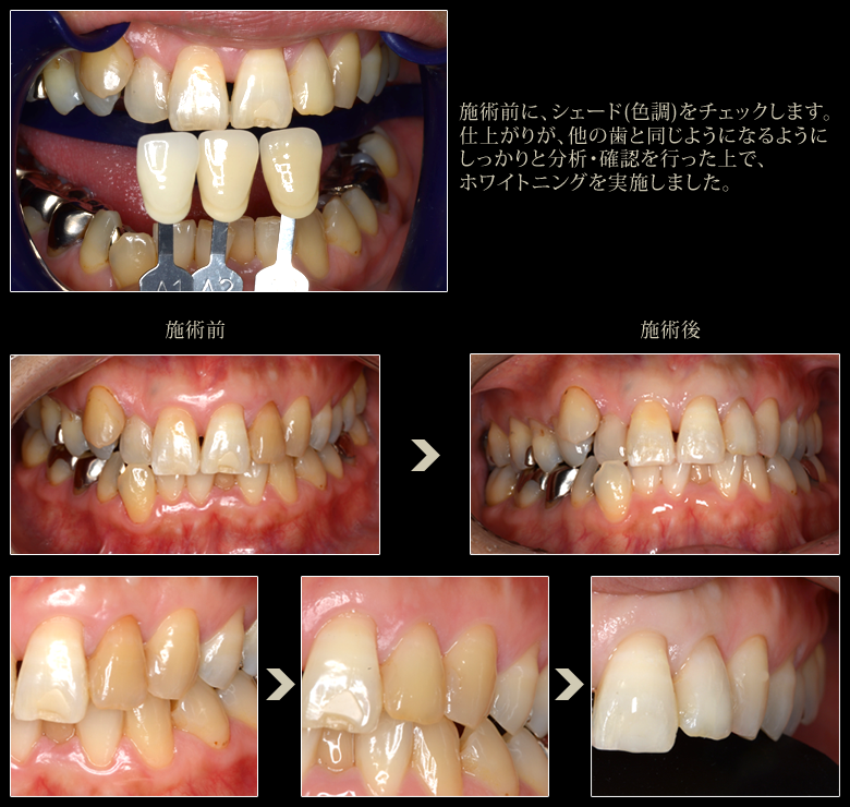 審美歯科症例:ホワイトニング4