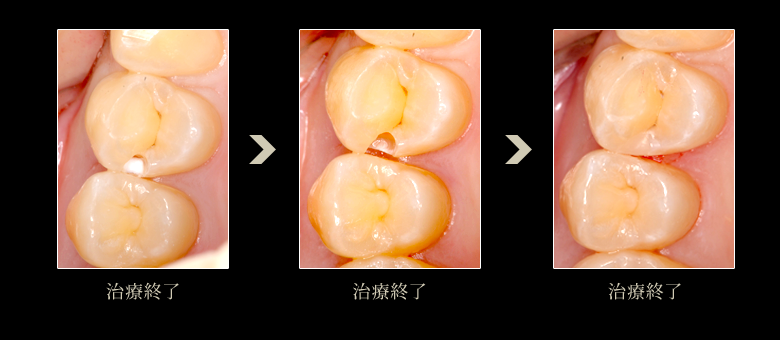 審美歯科症例:ダイレクトボンディング4