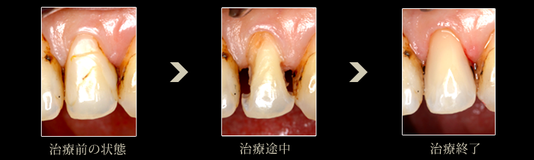 審美歯科症例:ダイレクトボンディング7