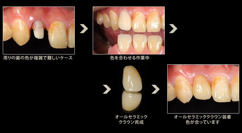 審美歯科症例:クラウン(被せ物)10